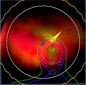 Proton beam therapy for eye tumours