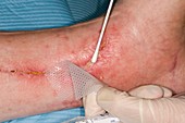 Infected heart bypass wound on leg