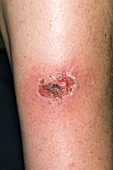 Infected insect bite