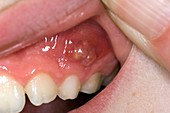 Dental abscess in a child