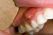 Dental abscess in a child