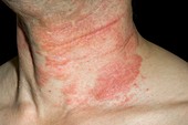 Eczema rash on the neck