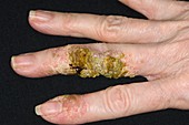 Infected eczema on the fingers