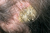 Infected eczema on the scalp