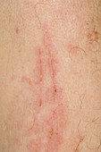 Scratch marks on arm in eczema