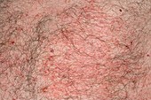 Acute eczema on body in sarcoidosis