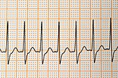 Junctional rhythm of the heartbeat