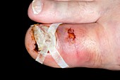 Fractured toe stepped on by horse