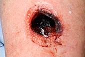 Treating haematoma after blunt injury
