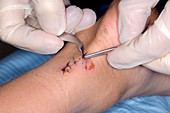 Removing sutures from a heel laceration