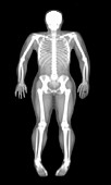 Bone density scan
