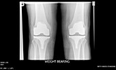 Knees after replacement surgery,X-ray