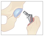 Hip replacement,artwork