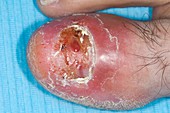 Infected toe after crush fracture