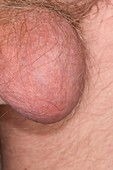 Inflamed testis in prostate cancer
