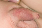 Balanitis of the penis with bruising