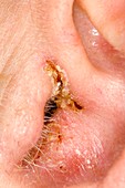 Eczema in the ear canal