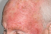 Dermatitis of the head from drug allergy