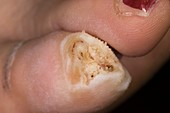 Loss of toenail in fungal infection