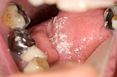 Oral thrush after tongue cancer surgery