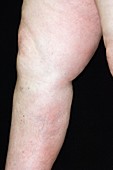 Deep vein thrombosis in the leg