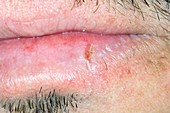 Fissure (crack) in the lip