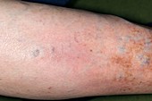 Superficial thrombophlebitis in the leg