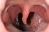Polyp on the uvula