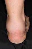 Swollen ankle from vasculitis