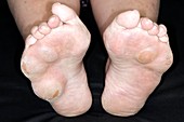 Rheumatoid nodules on soles of feet