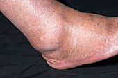 Osteoarthritis of the ankle