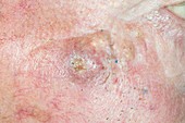 Basal cell carcinoma (skin cancer)