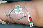 PICC intravenous chemotherapy device