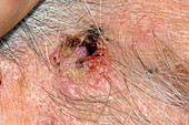 Basal cell skin cancer on the face