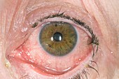 Red eye from bacterial conjunctivitis