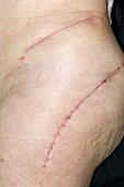 Scars from total hip replacement