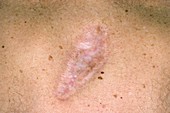 Scar on the skin after cancer removal