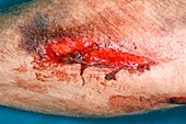 Skin wound after car accident