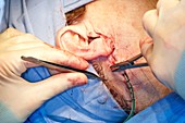 Parotid tumour surgery