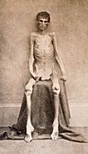 Malnourished prisoner,1860s