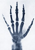 Early x-ray of a child's hand