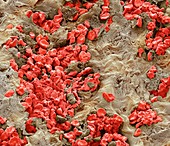 Tumour filled with blood,SEM