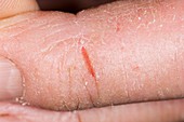 Cracked skin on finger in eczema