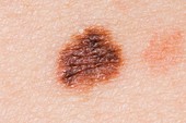 Atypical naevus (mole) on the skin