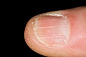 Longitudinal ridges along the fingernail