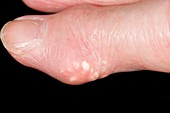 Gout tophus on the finger