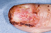 Squamous cell cancer under fingernail