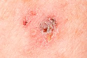 Melanoma skin cancer on the arm