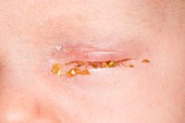 Sticky eyes in a newborn baby