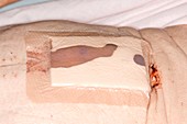 Treating an open laparotomy wound